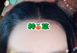 -大麦微针植发全国连锁