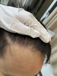 -大麦微针植发全国连锁