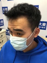 点击看大图 体验后-大麦微针植发丨全国连锁
