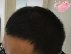 -大麦微针植发丨全国连锁