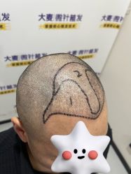 -大麦微针植发全国连锁