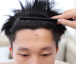 点击看大图 体验后-大麦微针植发全国连锁