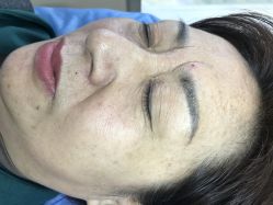 体验后-美丽人生祛斑扁平疣汗管瘤中心