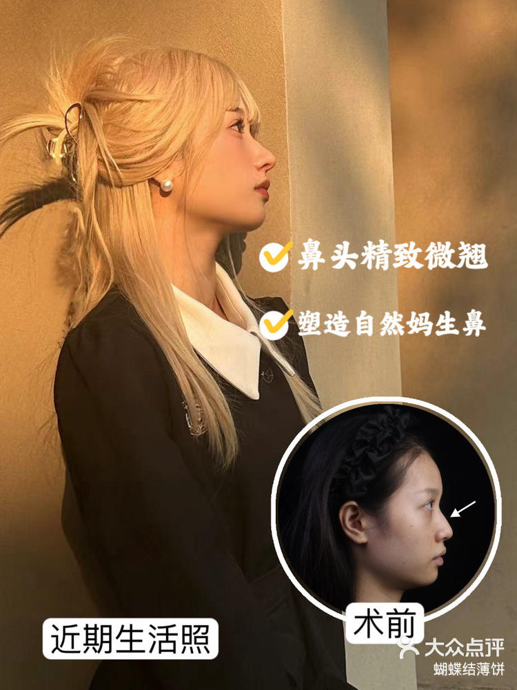 广州鼻综合精致小巧初恋鼻