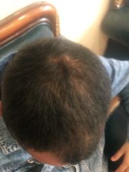 -碧莲盛·不剃发植发