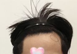 -大麦微针植发全国连锁