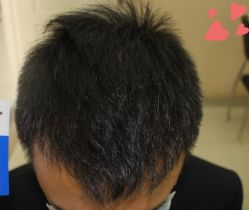 -大麦微针植发丨全国连锁