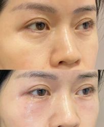 点击看大图 -美安心医美·美迪迈黄金微针·美拉美医疗美容
