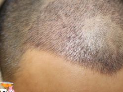 -大麦微针植发丨全国连锁