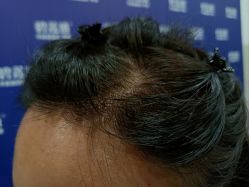 -碧莲盛·不剃发植发