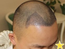 -大麦微针植发丨全国连锁