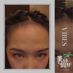 -大麦微针植发全国连锁
