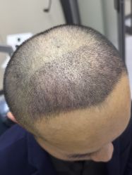 体验后-大麦微针植发全国连锁