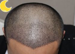 -大麦微针植发丨全国连锁