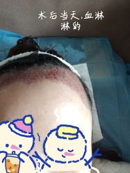 -碧莲盛·不剃发植发