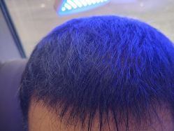 -碧莲盛·不剃发植发