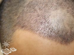 -大麦微针植发丨全国连锁