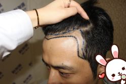 点击看大图 -大麦微针植发丨全国连锁