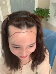 点击看大图 -大麦微针植发丨全国连锁