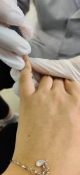 -德哥灰指甲脚气甲沟炎跖疣护理
