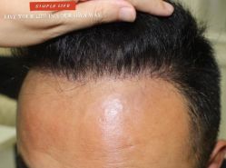 -大麦微针植发丨全国连锁