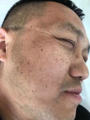 -美丽人生祛斑扁平疣汗管瘤中心