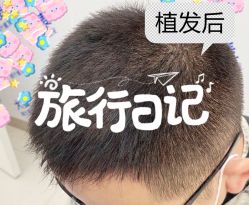 -大麦微针植发全国连锁