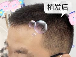 -大麦微针植发全国连锁