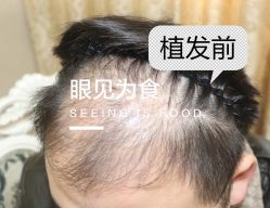 -大麦微针植发全国连锁