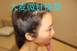 -大麦微针植发丨全国连锁