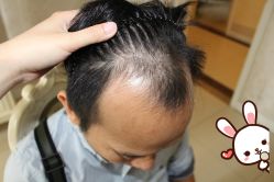 -大麦微针植发丨全国连锁