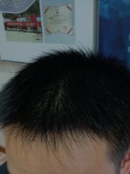 -碧莲盛·不剃发植发