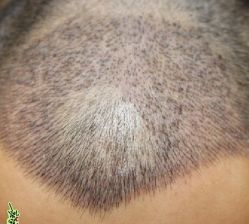 -大麦微针植发丨全国连锁