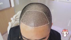 -大麦微针植发丨全国连锁