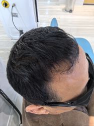 体验后-雍禾植发全国连锁