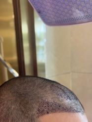 -碧莲盛·不剃发植发