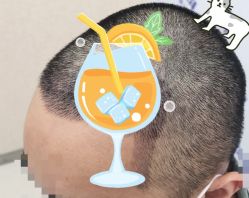 -大麦微针植发全国连锁