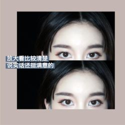 -碧莲盛·不剃发植发