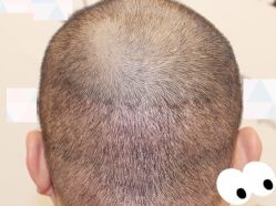 -大麦微针植发全国连锁