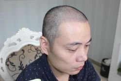 -大麦微针植发丨全国连锁