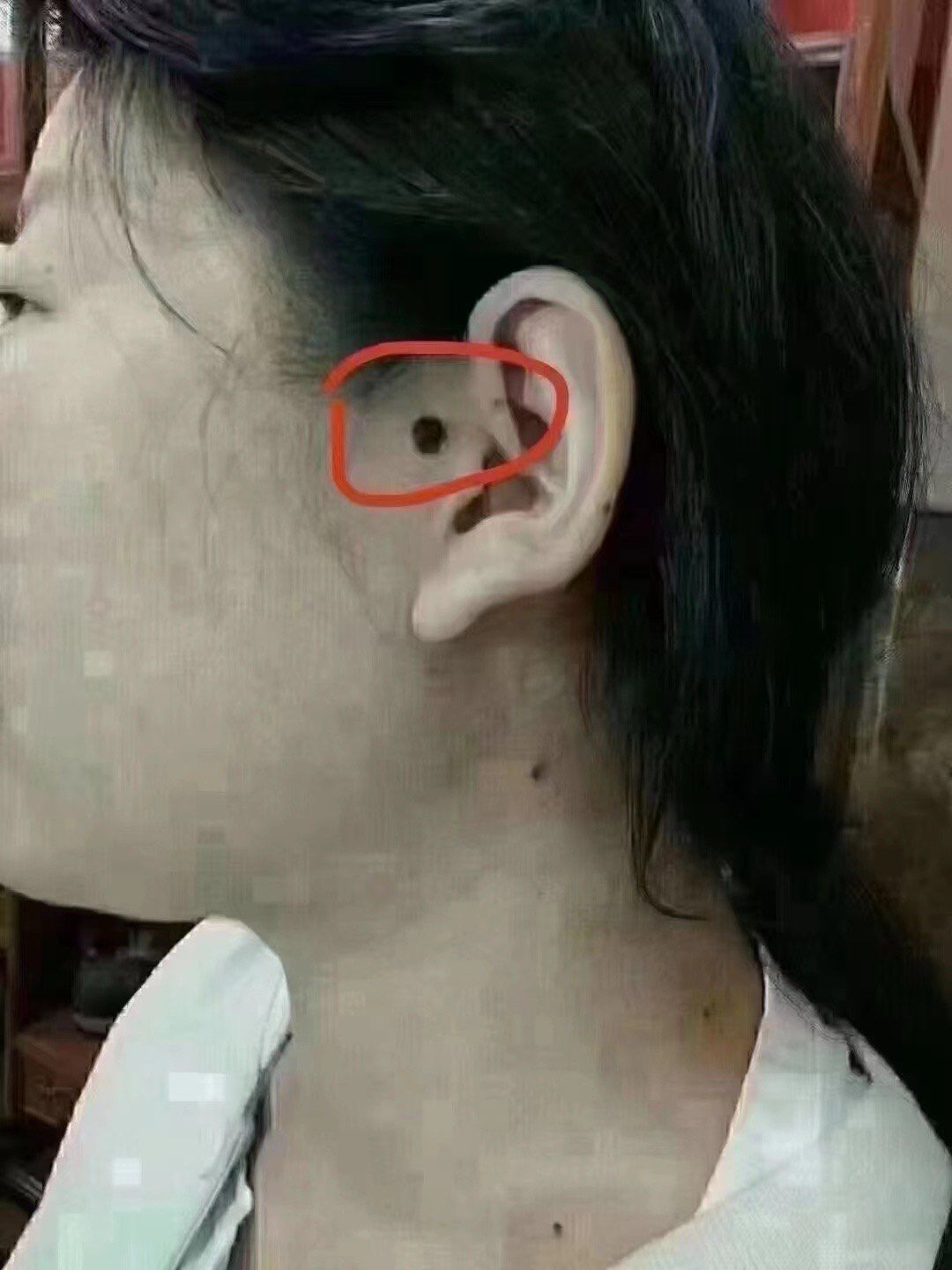 看看这颗痣你有吗?