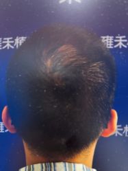 -雍禾植发全国连锁