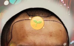 -大麦微针植发全国连锁