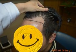 -大麦微针植发全国连锁