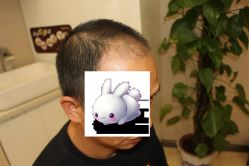 -大麦微针植发丨全国连锁