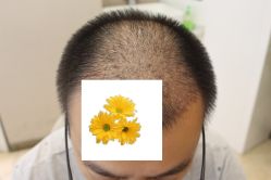 -大麦微针植发丨全国连锁