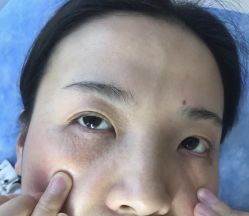 -美丽人生祛斑扁平疣汗管瘤中心