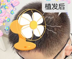 -大麦微针植发全国连锁