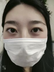 体验后-紫洁俪方（北京）医疗美容