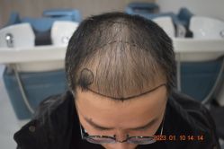 -大麦微针植发全国连锁